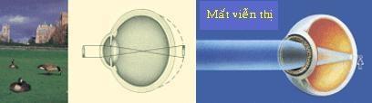 nhãn cầu viễn thị Mắt viễn thị