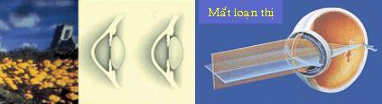 loạn thị Mắt loạn thị
